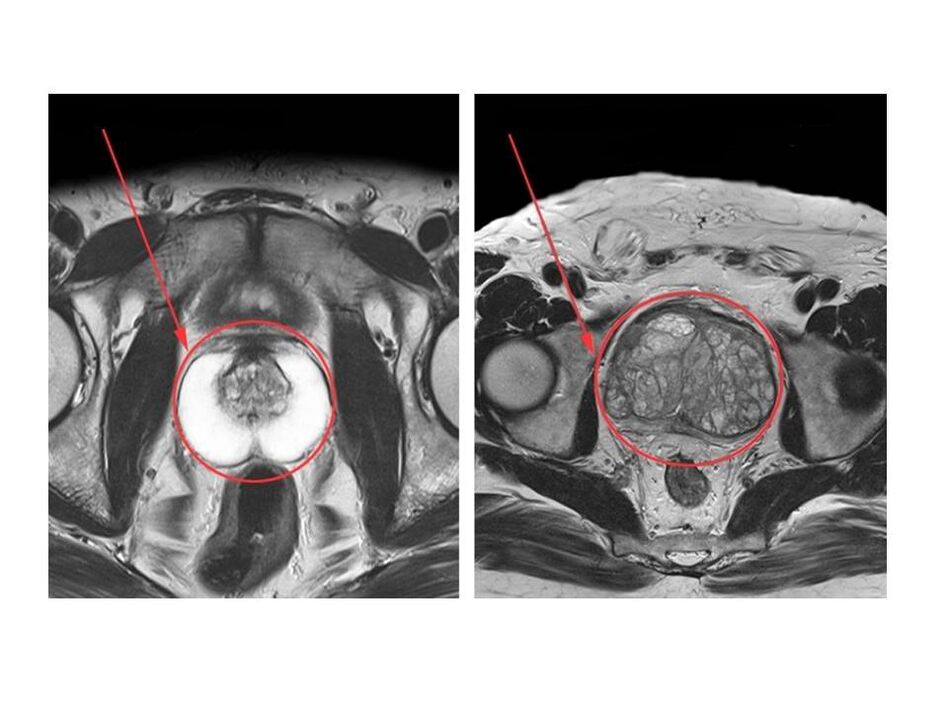 Comparaison entre une prostate saine (à gauche) et une prostate enflammée (à droite) sur les images IRM